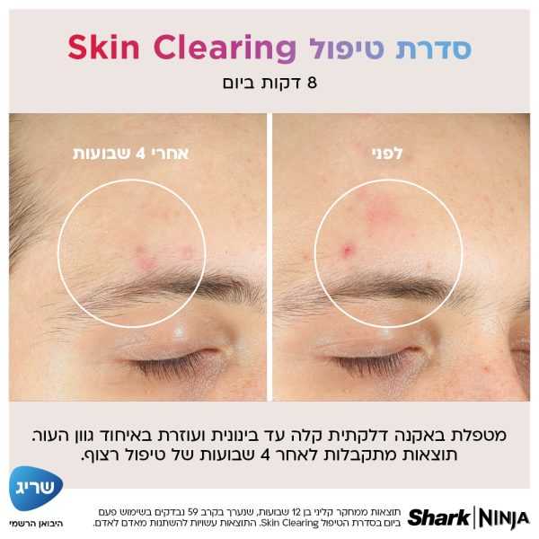 טכנולוגיית iQLED אורך גל כחול אדום ואינפרה אדום בשכבות העור הדרמיס והאפידרמיס